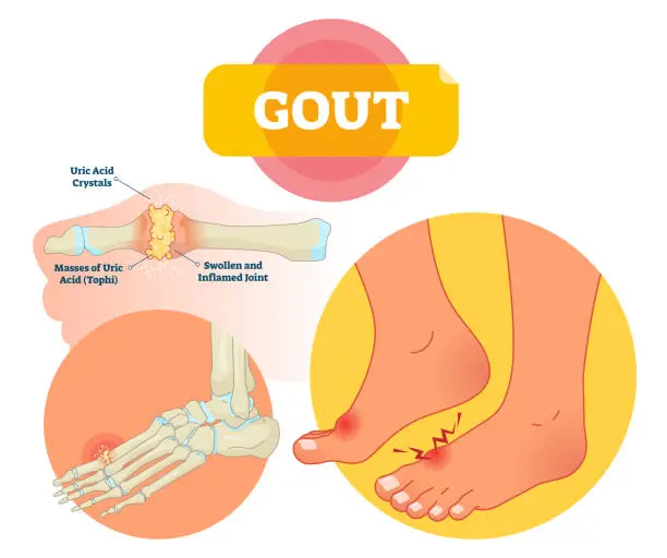 Uric Acid disease