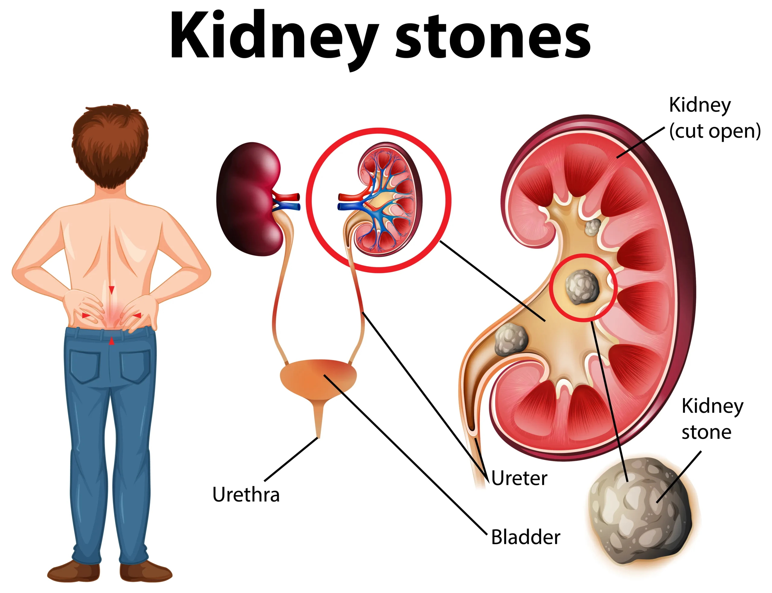 kidney stone